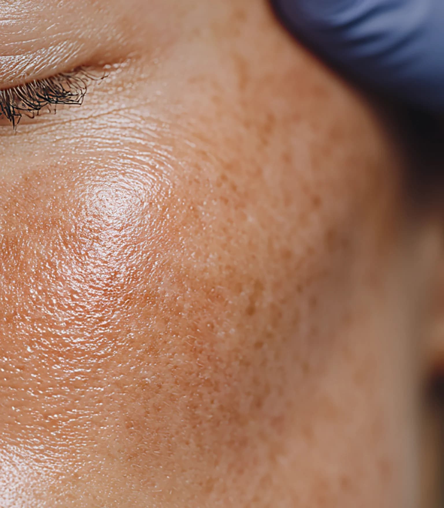 Pigmentation Treatment