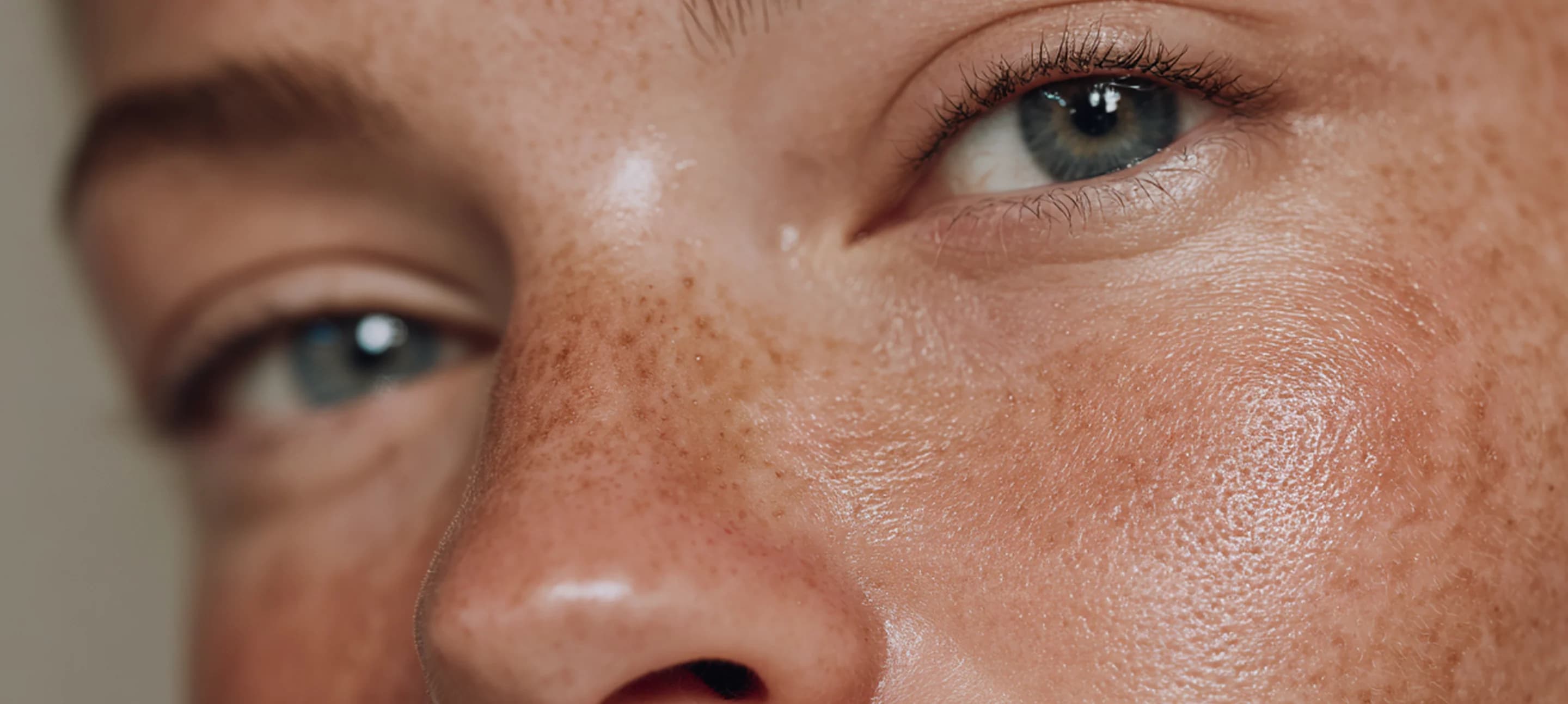 Rosacea Treatment