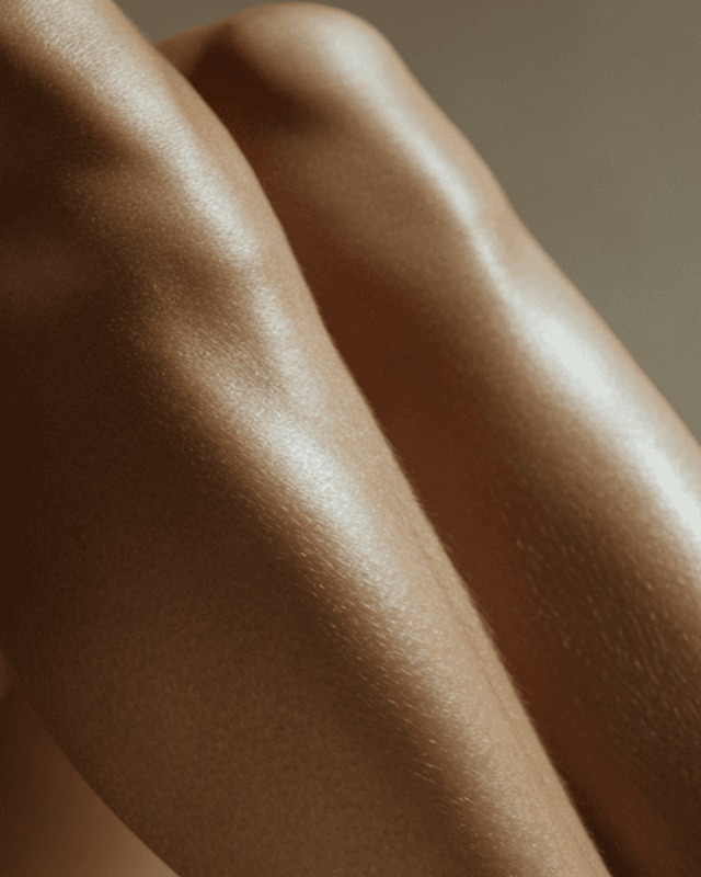 Vein Removal (Sclerotherapy)